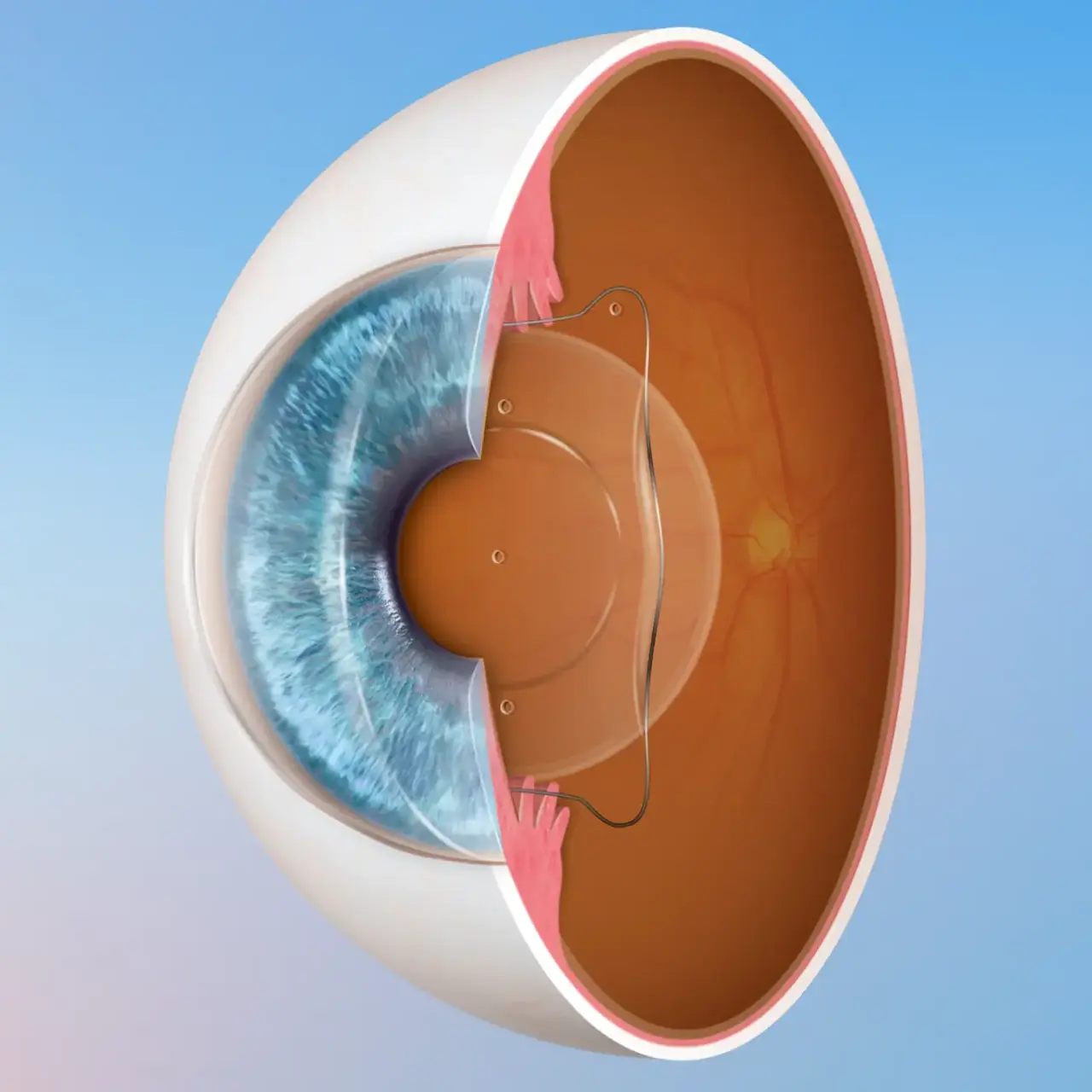 Cross-section illustration of an eye showing the EVO ICL positioned behind the iris and in front of the natural lens