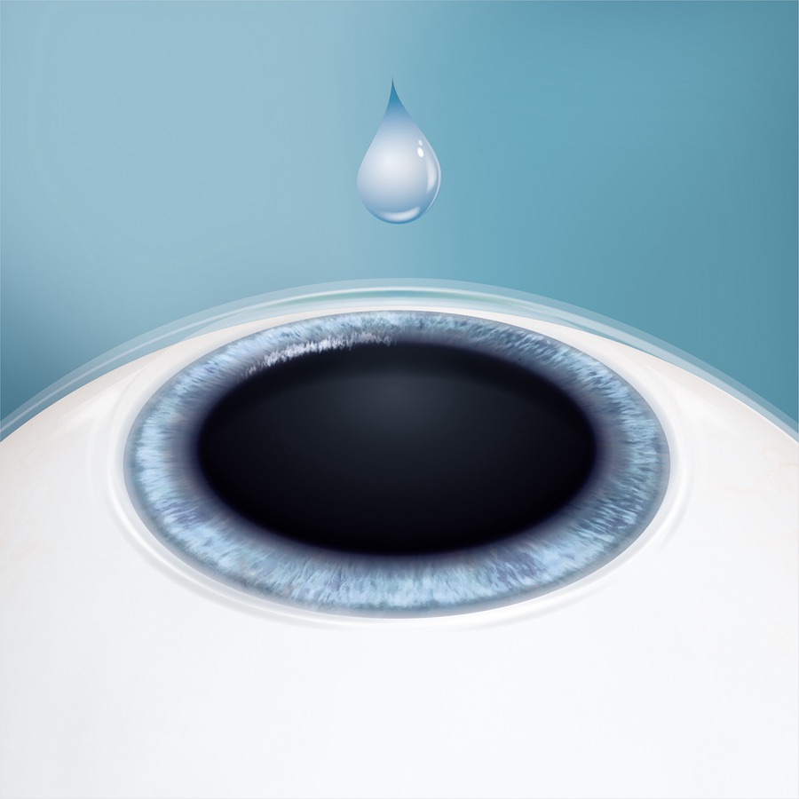 An anesthetic drop above the eye at the start of the EVO ICL procedure