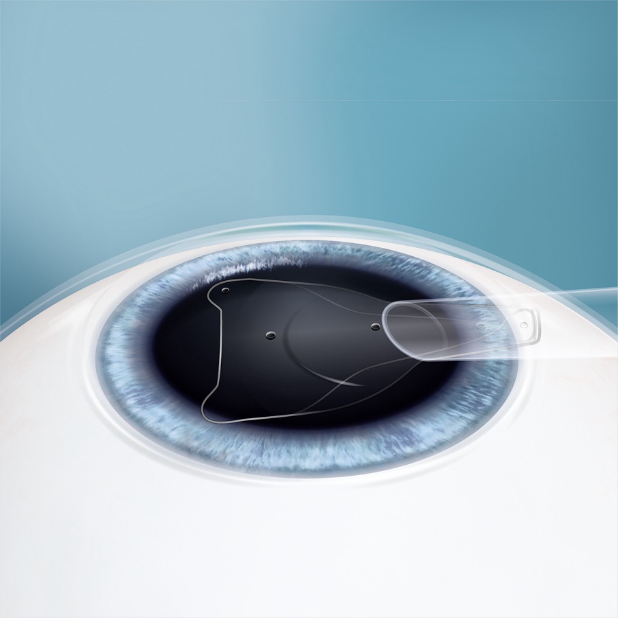 The folded EVO ICL lens entering the eye through a micro-incision