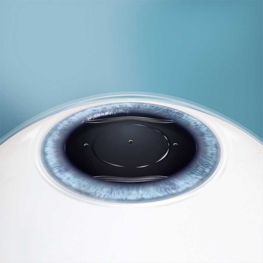 The EVO ICL lens tucked behind the iris in its final resting position