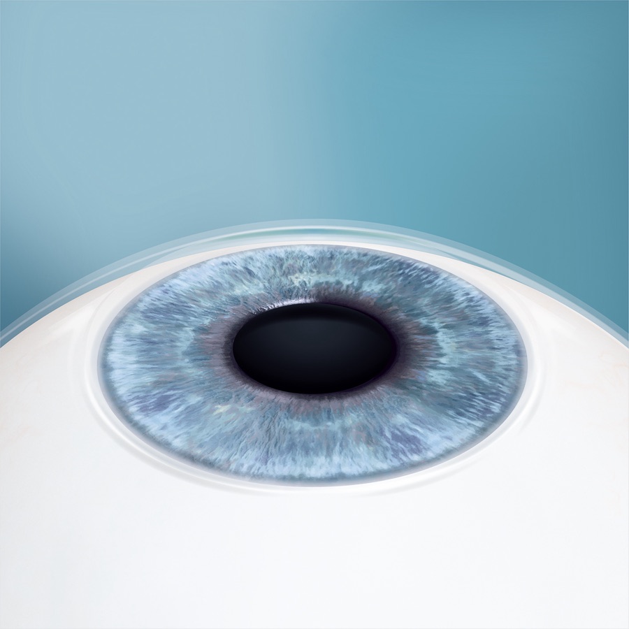An eye after EVO ICL, with the implanted lens completely invisible